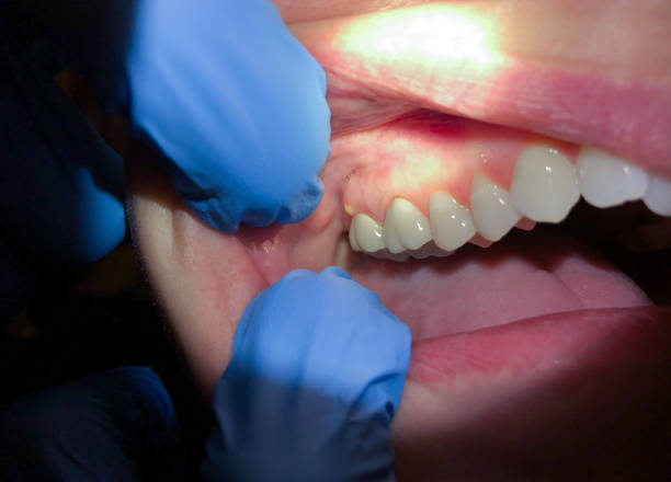 Best Emergency Dentist for Lost Fillings or Crowns in , WA